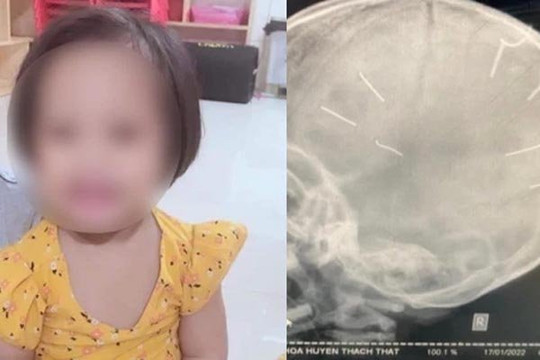 Bàn giao nhân tình mẹ bé gái 3 tuổi nghi bị bắn đinh vào đầu cho phòng cảnh sát hình sự