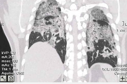 F0 không có triệu chứng, phổi vẫn trắng xoá hậu Covid-19