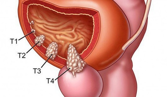 Ung thư bàng quang dễ di căn đến những bộ phận này?