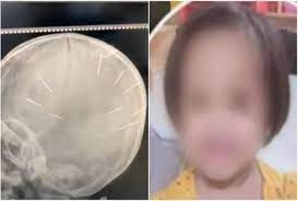 Bé gái 3 tuổi bị người tình của mẹ găm đinh vào đầu ở Hà Nội đã tử vong: Hung thủ đối diện với mức án nào?