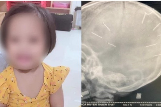 Bác sĩ lý giải nguyên nhân tử vong của bé 3 tuổi bị đóng đinh vào đầu