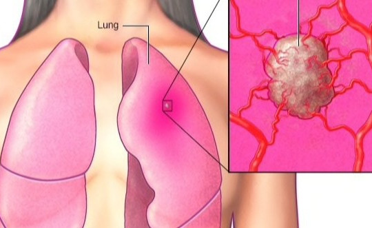 Khó thở, tức ngực đi khám, người phụ nữ phát hiện ung thư phổi di căn