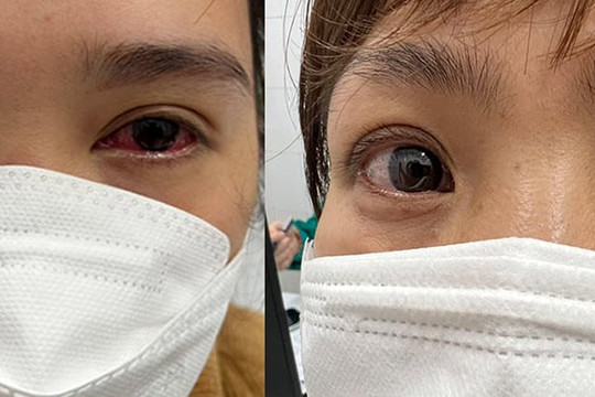 Hậu COVID-19, nhiều F0 gặp di chứng ở mắt