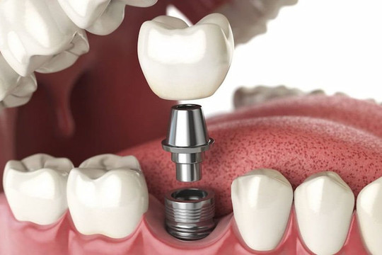 Trồng răng Implant có đau không? Top 3 cách giảm sưng đau khi trồng răng