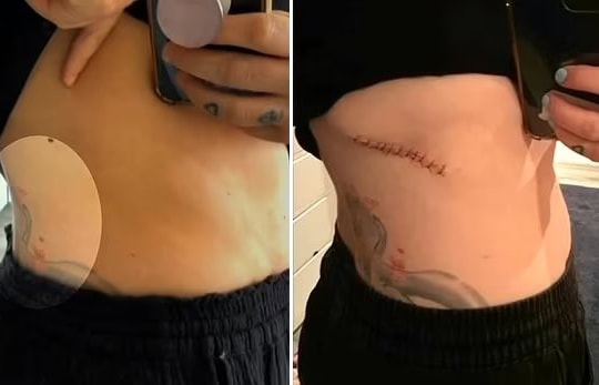 Người phụ nữ 32 tuổi phát hiện bị ung thư nhờ một chấm nhỏ sau lưng