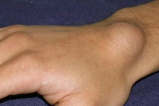 Nổi u, cục ở cổ tay: Có phải là dấu hiệu ung thư?