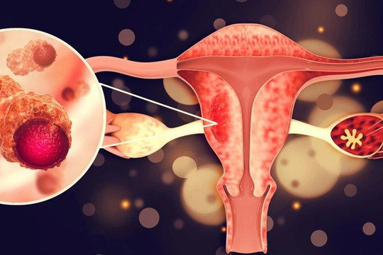 Chứng rối loạn phổ biến ở phụ nữ có thể dẫn đến ung thư buồng trứng