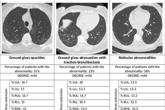 Hình ảnh phổi của bệnh nhân sau một năm khỏi Covid-19