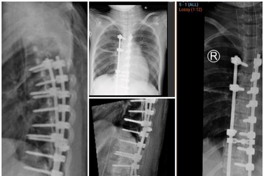 Bác sĩ dùng 32 ốc vít giữ cột sống cho bé gái 11 tuổi