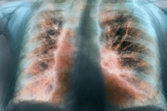 Ai dễ bị xơ phổi hậu Covid-19?