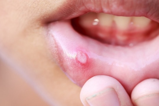 Ung thư miệng có làm bạn bị mất vị giác không?