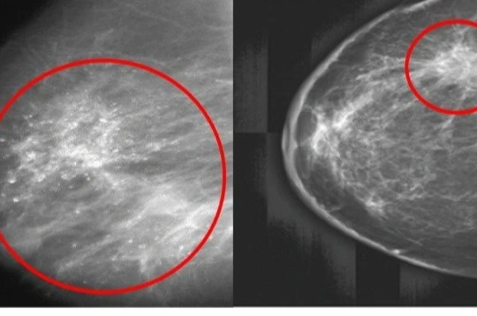 Ý nghĩa của các phương pháp sàng lọc ung thư vú