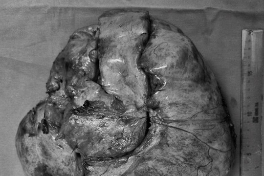 Phẫu thuật thành công khối u màng phổi nặng hơn 5 kg