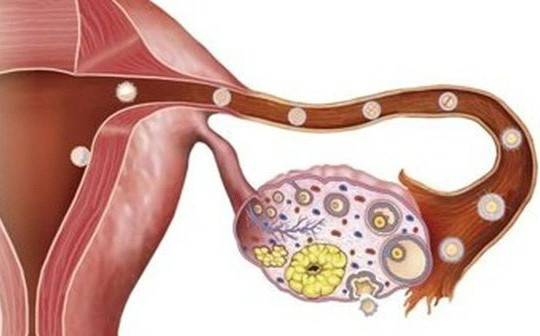 Các phương pháp phát hiện sớm ung thư buồng trứng