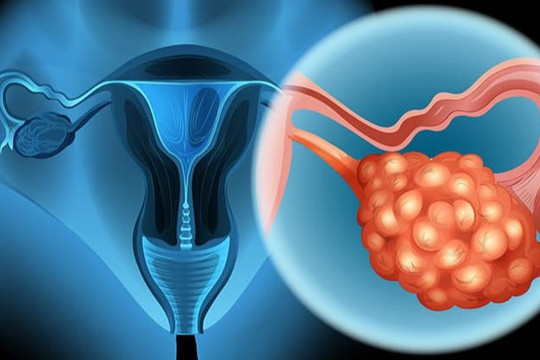 7 dấu hiệu âm thầm của ung thư buồng trứng thường bị bỏ qua