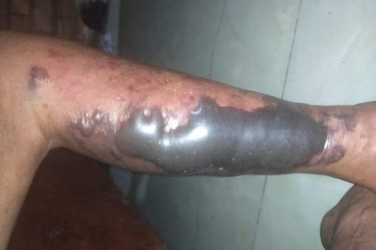 Người đàn ông nuôi tôm ở Cà Mau suýt tử vong vì vi khuẩn lạ