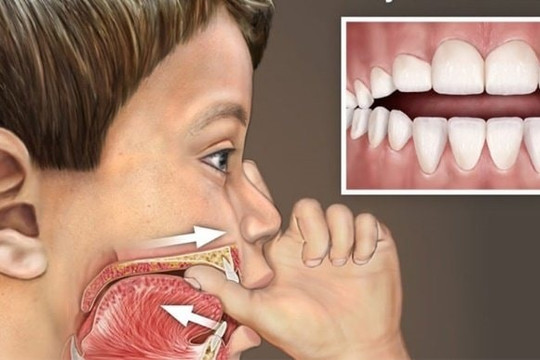 Mút tay, bú bình kéo dài làm ảnh hưởng sức khoẻ răng miệng của trẻ