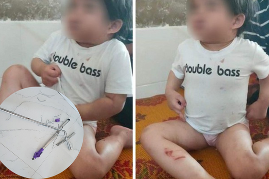 Tạm giữ dì ruột dùng chổi sắt đánh cháu gái 4 tuổi nhập viện