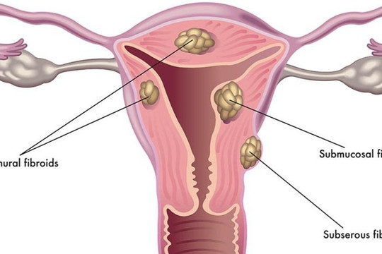 Các triệu chứng của u xơ tử cung là gì?