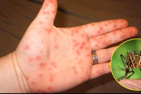 4 giai đoạn của bệnh sốt xuất huyết: Giai đoạn 3 cần chú ý vì dễ nguy hiểm