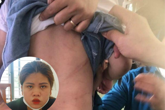 Khởi tố vụ án dì ruột dùng cán chổi đánh cháu gái 4 tuổi ở Hà Tĩnh
