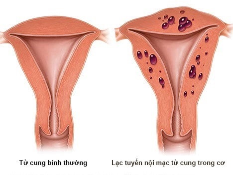 Những cơn đau bất thường báo hiệu nguy cơ gây ra vô sinh ở phụ nữ