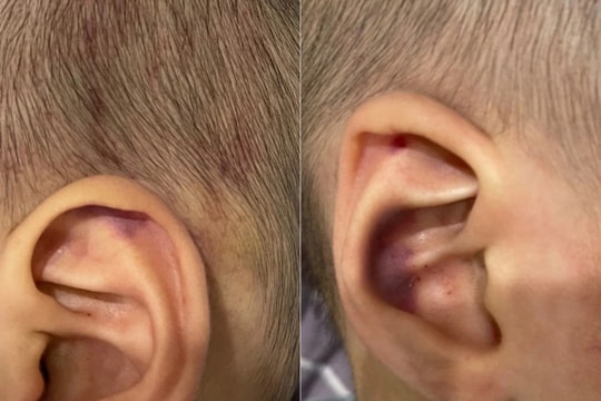 Công an điều tra vụ bé trai 2 tuổi nghi bị cô giáo đánh tím đầu