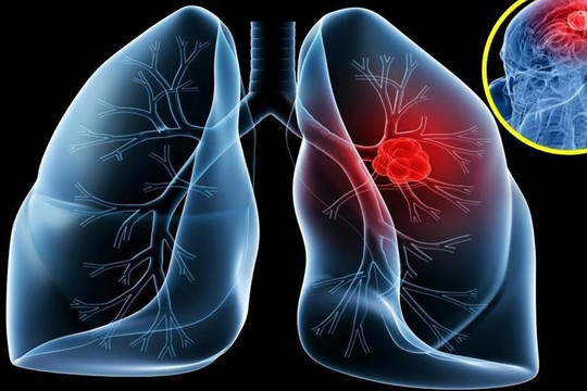 Vai trò của liệu pháp miễn dịch trong điều trị ung thư phổi