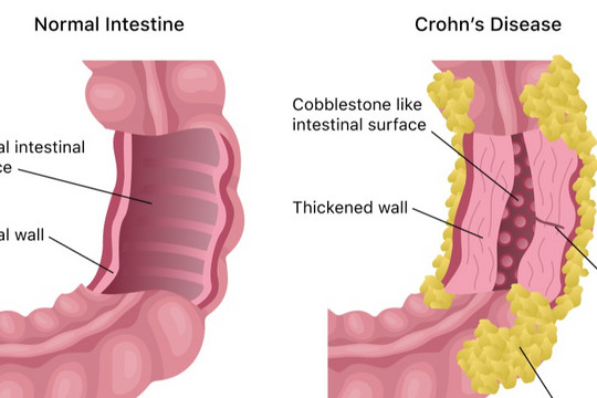 Bệnh Crohn có làm tăng nguy cơ ung thư không?