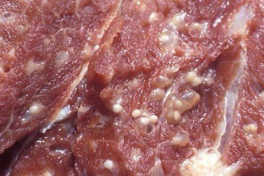 Thói quen ăn tiết canh, thịt tái...có thể dẫn đến nhiễm sán lợn, nguy hiểm tính mạng