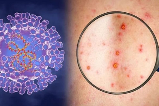 Phát hiện chủng virus đậu mùa khỉ thứ hai đang lây lan