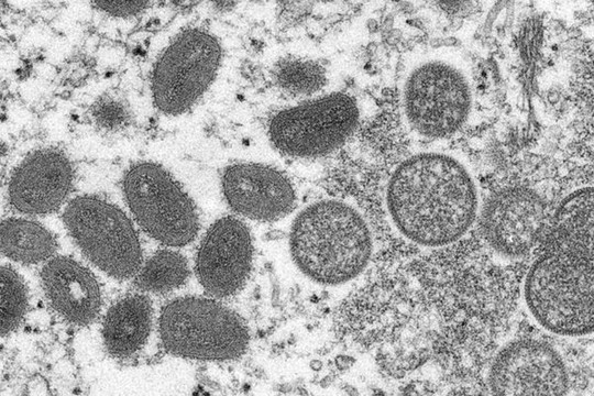Chủng virus đậu mùa khỉ có 47 đột biến mới