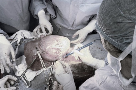 Người phụ nữ được phẫu thuật thành công khối u “trú ẩn” 10 năm