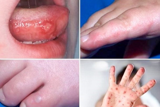 3 triệu chứng báo hiệu bệnh tay chân miệng trở nặng