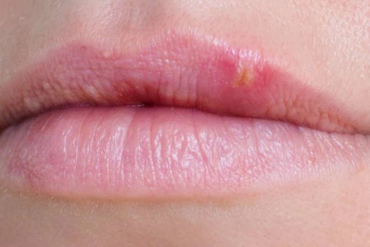 Vết sưng trên môi có phải ung thư?