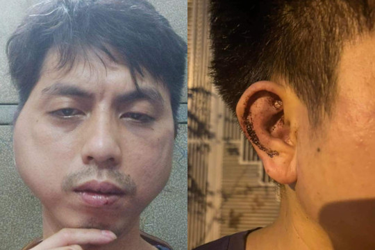 Hà Nội: Thanh niên tố bị chủ quán đánh thủng màng nhĩ vì xin nghỉ việc