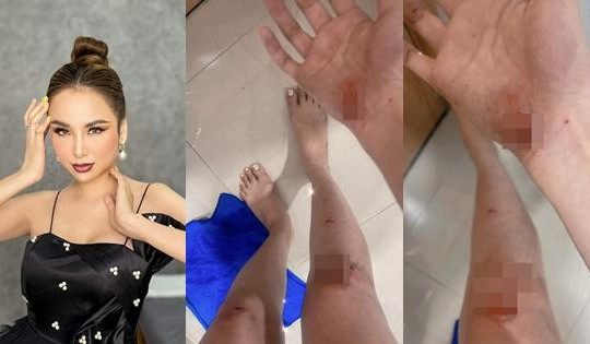 Hoa hậu Diễm Hương gặp chấn thương giữa lùm xùm đời tư