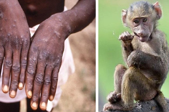 WHO: đậu mùa khỉ chưa phải là tình trạng khẩn cấp y tế toàn cầu