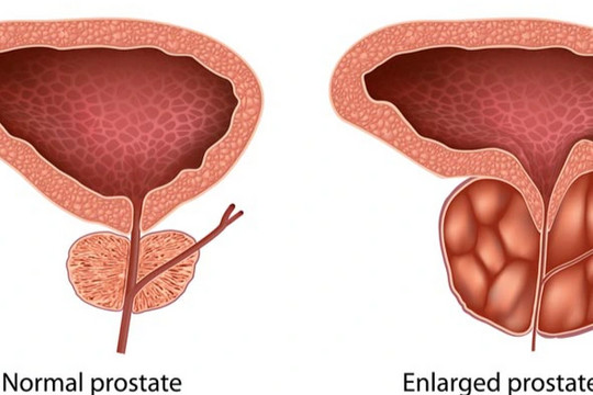 Triệu chứng cảnh báo nam giới bị phì đại tuyến tiền liệt
