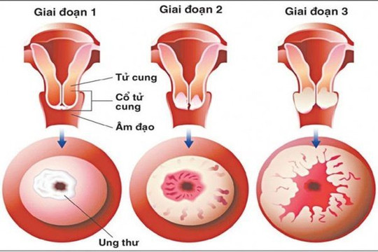 Những biến chứng nguy hiểm do ung thư cổ tử cung