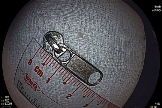 Nội soi, gắp chiếc khóa sắt dài 2,5cm trong dạ dày em bé 6 tuổi