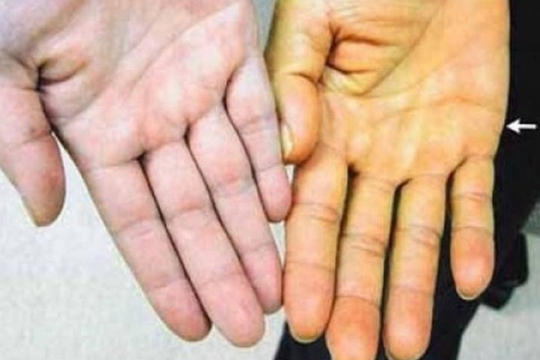 Những dấu hiệu cảnh báo lá gan đang "kêu cứu"