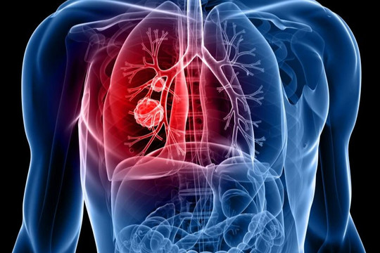 5 hiểu lầm phổ biến về ung thư phổi