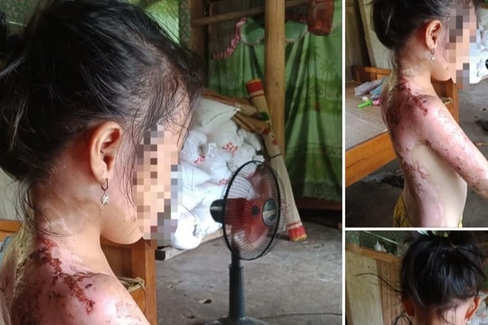 Bị hàng xóm hắt nước sôi, bé 7 tuổi bỏng nặng