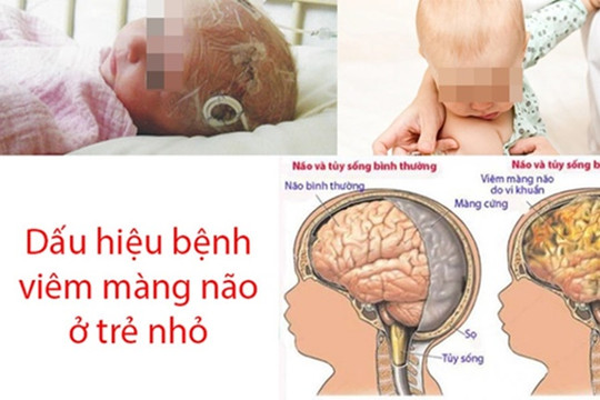 Những dấu hiệu nào báo hiệu bệnh viêm màng não ở trẻ em?