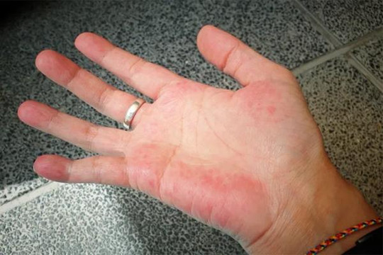 Biểu hiện trên bàn tay của người mắc bệnh gan
