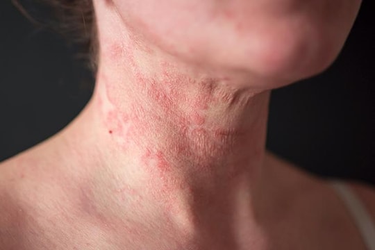 Sáu chất bổ sung cần thiết khi mắc bệnh chàm ngứa