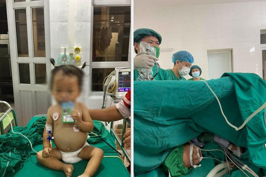 Yên Bái: Phẫu thuật tán sỏi qua da cứu sống cháu bé 24 tháng tuổi