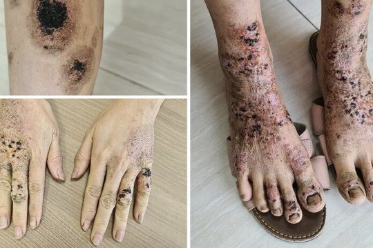 TPHCM: Người phụ nữ bị lở loét tay chân vì bôi thảo dược chứa corticoid