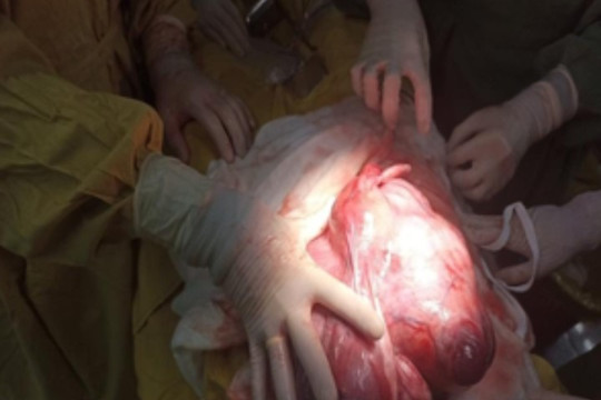 Hậu Giang: Phẫu thuật thành công u xơ tử cung nặng 4,5 kg